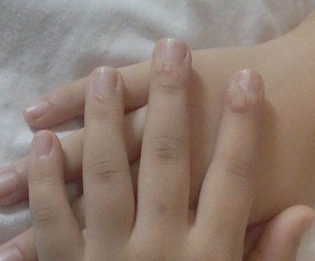 사마귀 치료 전