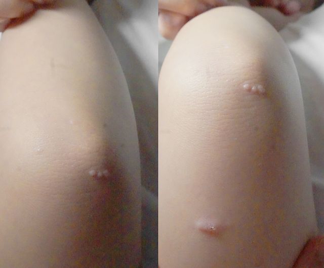 사마귀 치료 전