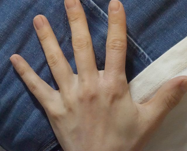 45세 여성 · 6개월 경과