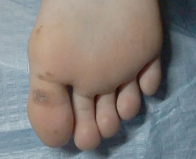 사마귀 치료 전