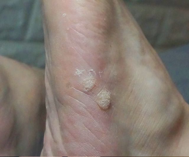사마귀 치료 전