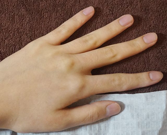 23세 여성 · 7개월 경과
