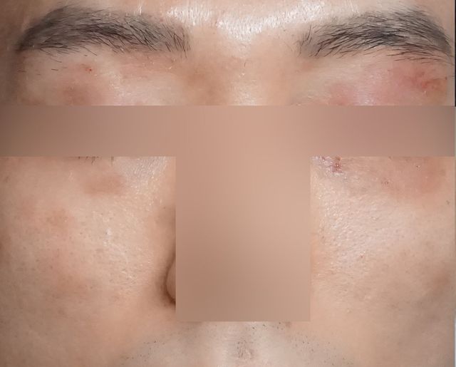 아토피 치료 전