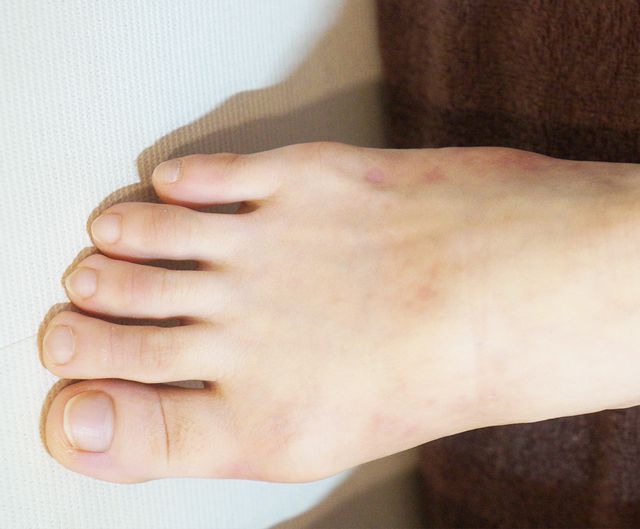 22세 여성 · 7개월 경과