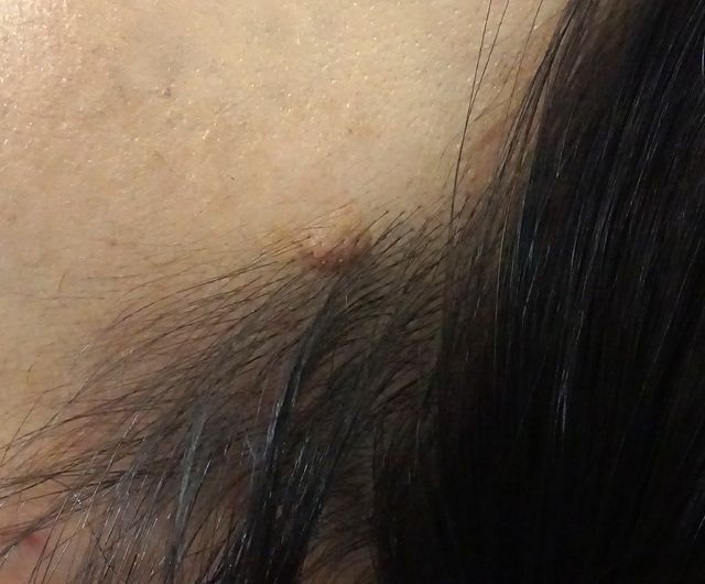 사마귀 치료 전