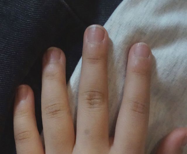 10세 여성 · 8개월 경과