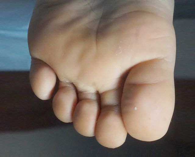 8세 남성 · 5개월 경과
