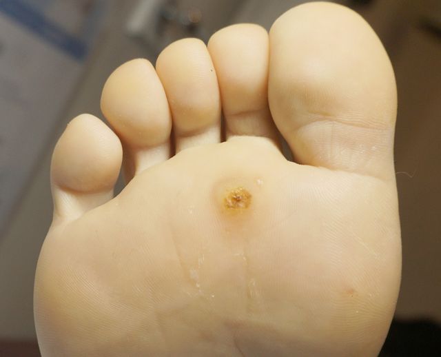 사마귀 치료 전