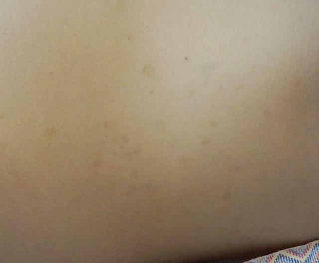 34세 여성 · 6개월 경과