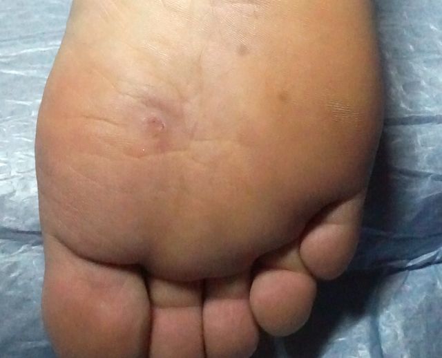 사마귀 치료 전