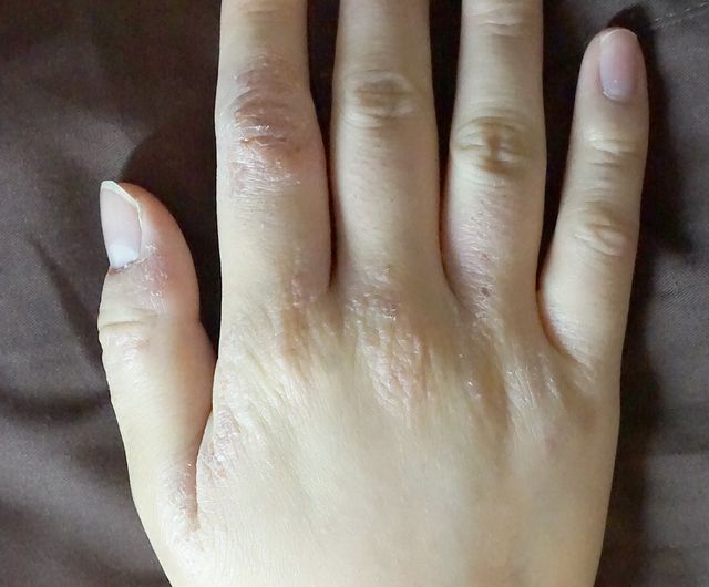 한포진 치료 전