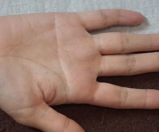 36세 여성 · 2개월 경과